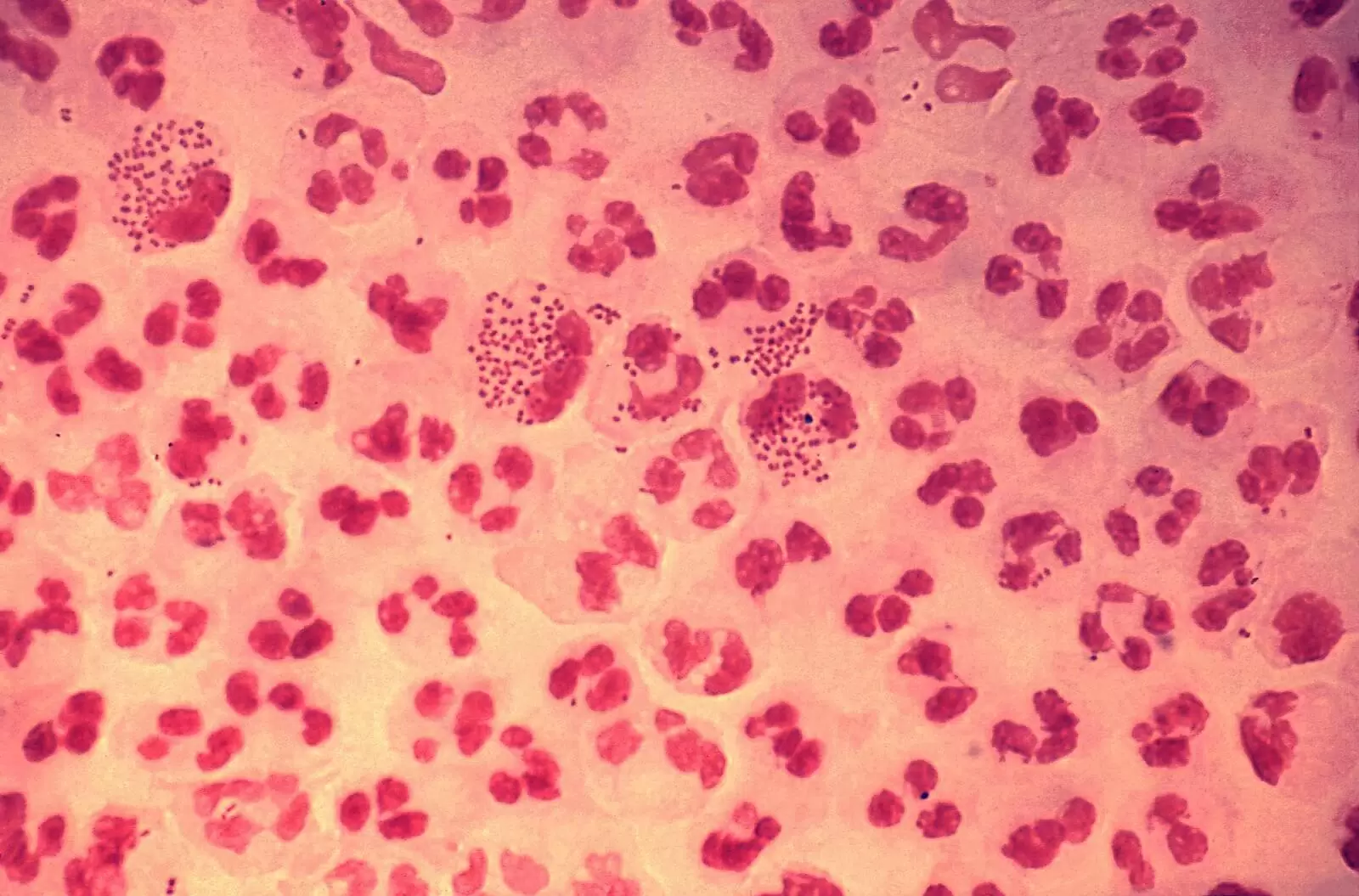 Gonorrhoea Close Up.jpg